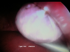 SPECIMEN EXTRACTION